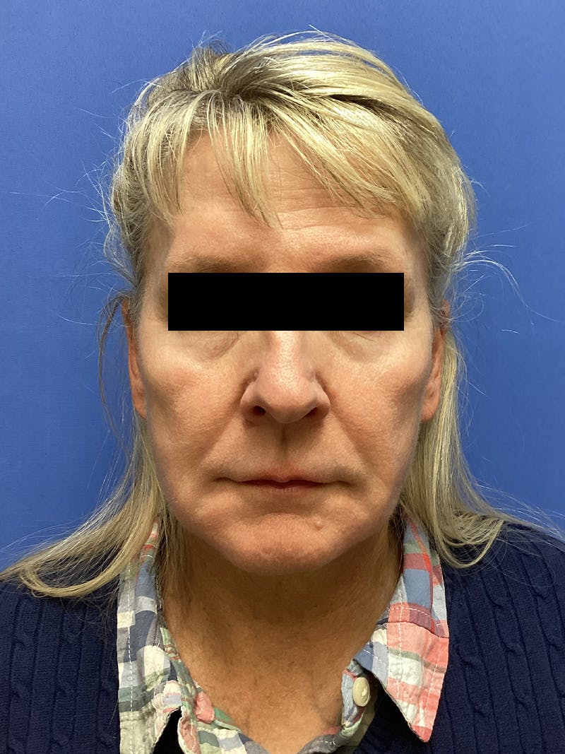 Facelift Before & After Gallery - Patient 174872 - Image 1