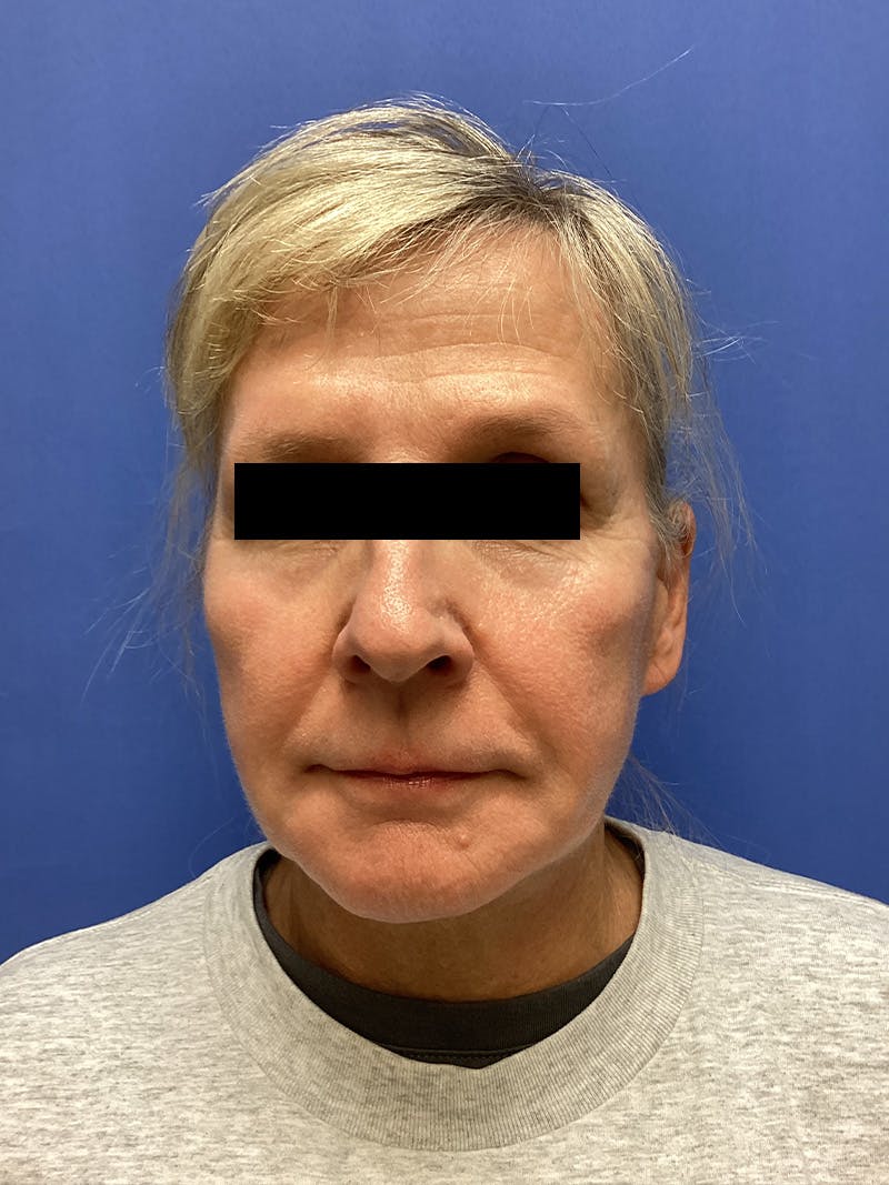 Facelift Before & After Gallery - Patient 174872 - Image 2