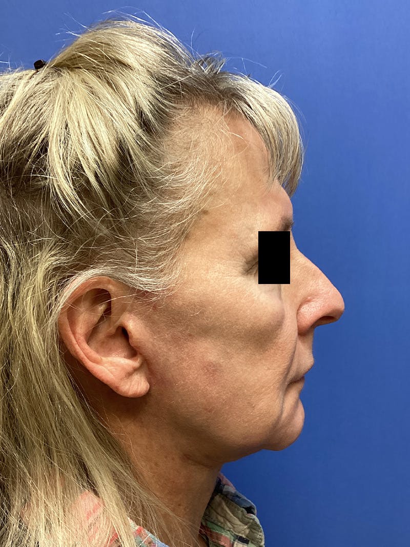 Facelift Before & After Gallery - Patient 174872 - Image 5
