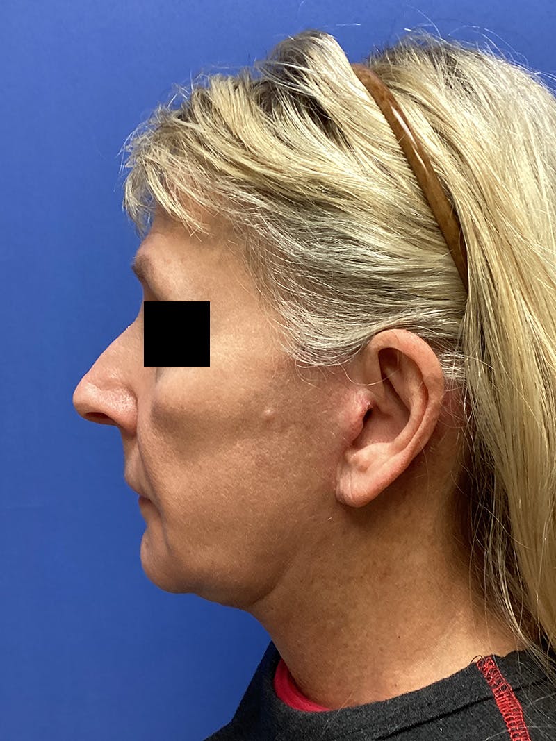 Facelift Before & After Gallery - Patient 174872 - Image 7