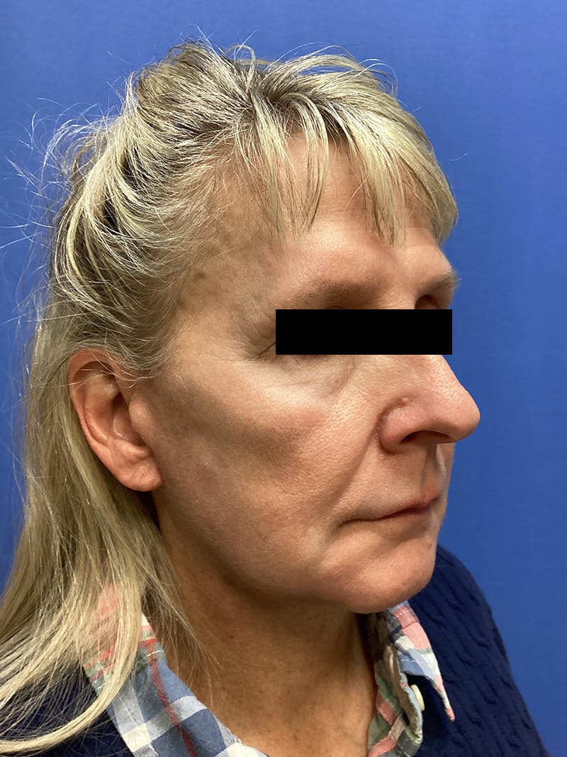 Facelift Before & After Gallery - Patient 174872 - Image 3