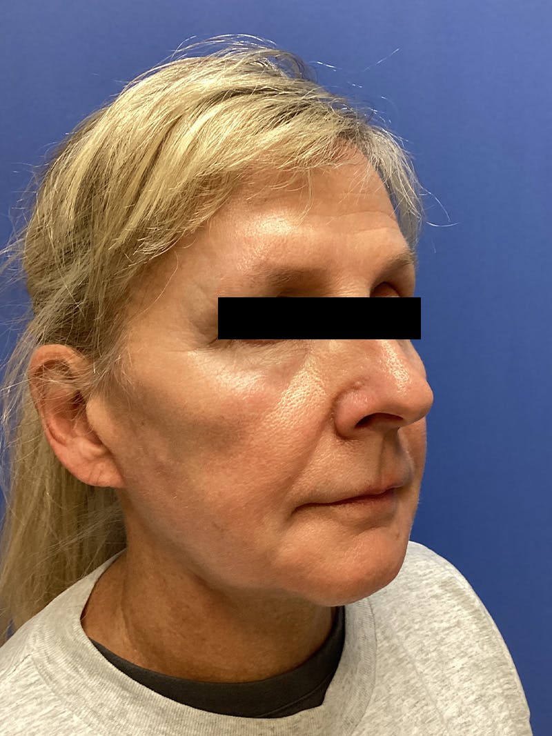 Facelift Before & After Gallery - Patient 174872 - Image 4