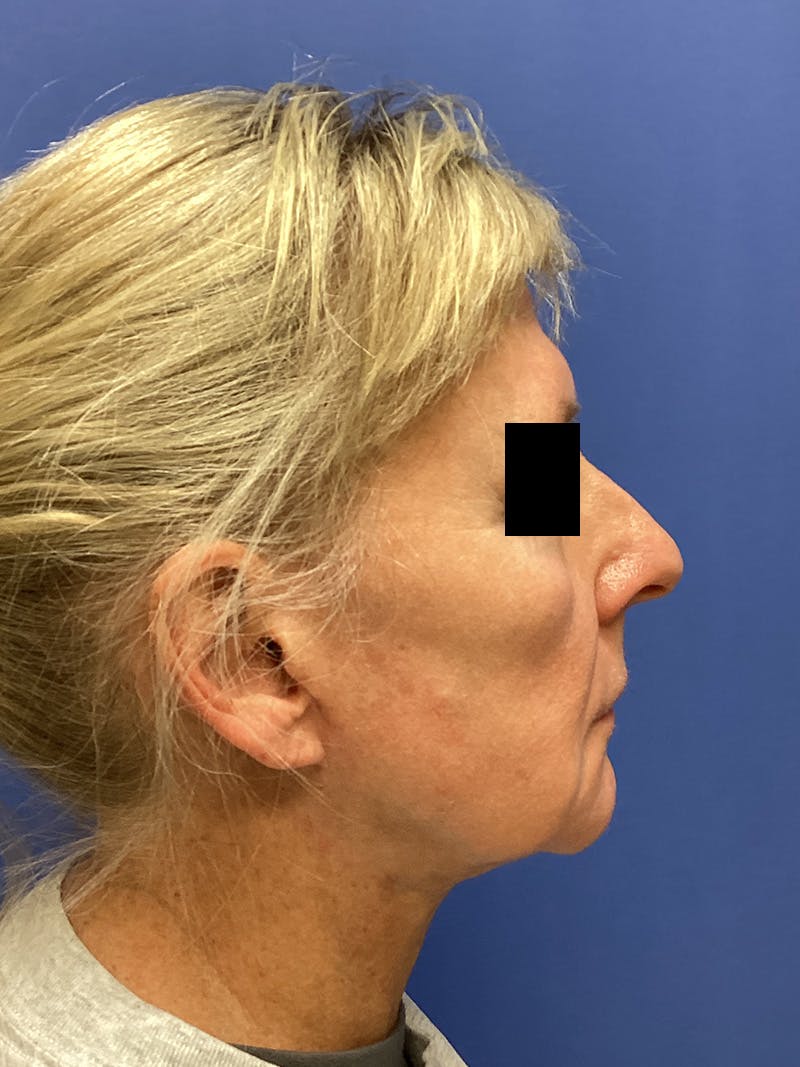 Facelift Before & After Gallery - Patient 174872 - Image 6