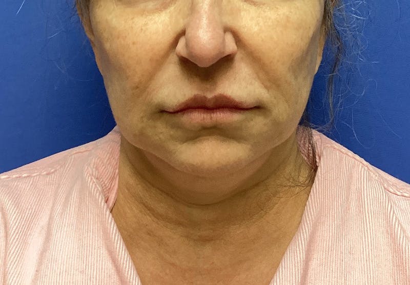 Submental Liposuction Before & After Gallery - Patient 167017 - Image 3