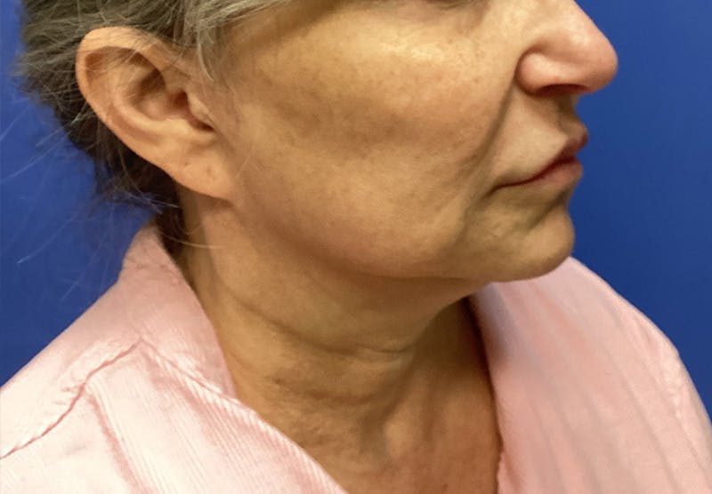 Submental Liposuction Before & After Gallery - Patient 167017 - Image 5