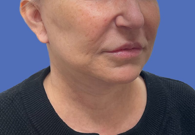 Submental Liposuction Before & After Gallery - Patient 167017 - Image 6