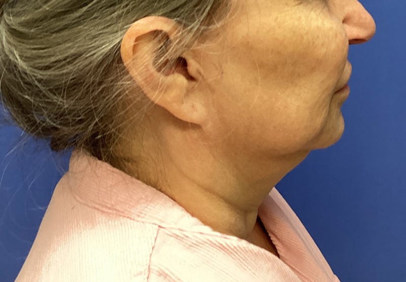 Submental Liposuction Before & After Gallery - Patient 167017 - Image 7