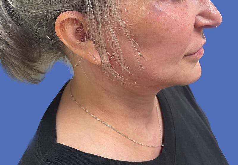 Submental Liposuction Before & After Gallery - Patient 167017 - Image 8