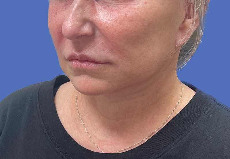 Submental Liposuction Before & After Gallery - Patient 167017 - Image 10