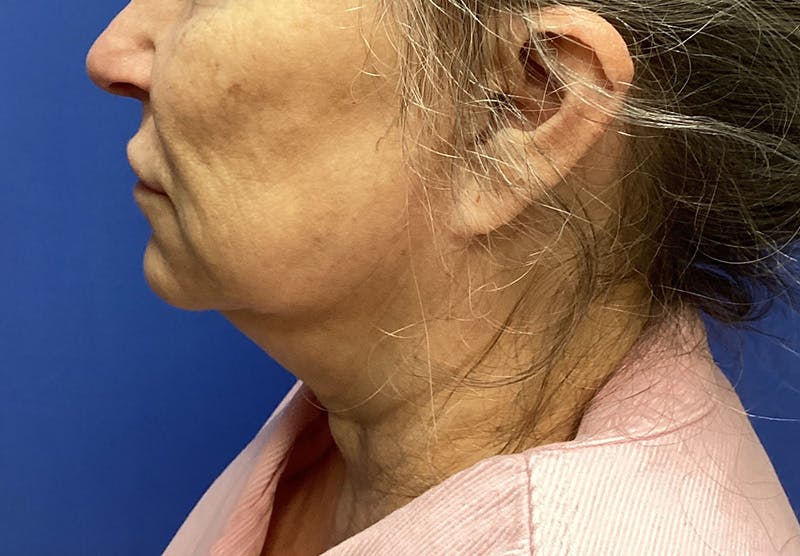 Before and after Neck Lift