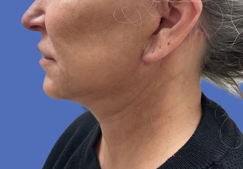 Before and after Neck Lift