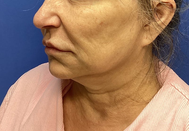 Submental Liposuction Before & After Gallery - Patient 167017 - Image 9
