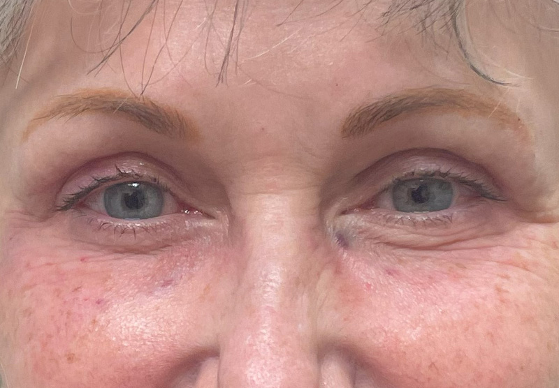 BLEPHAROPLASTY Before & After Gallery - Patient 311510 - Image 2