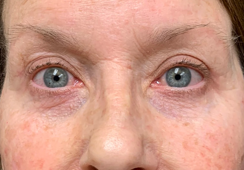 BLEPHAROPLASTY Before & After Gallery - Patient 337189 - Image 2