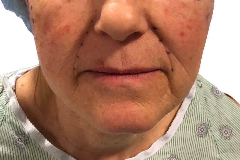 Neck Lift Before & After Gallery - Patient 215574 - Image 1