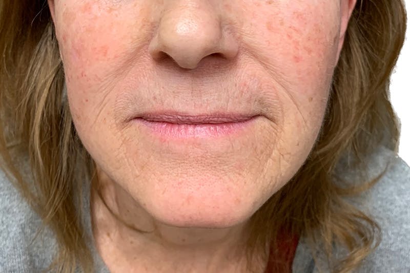 Neck Lift Before & After Gallery - Patient 215574 - Image 2