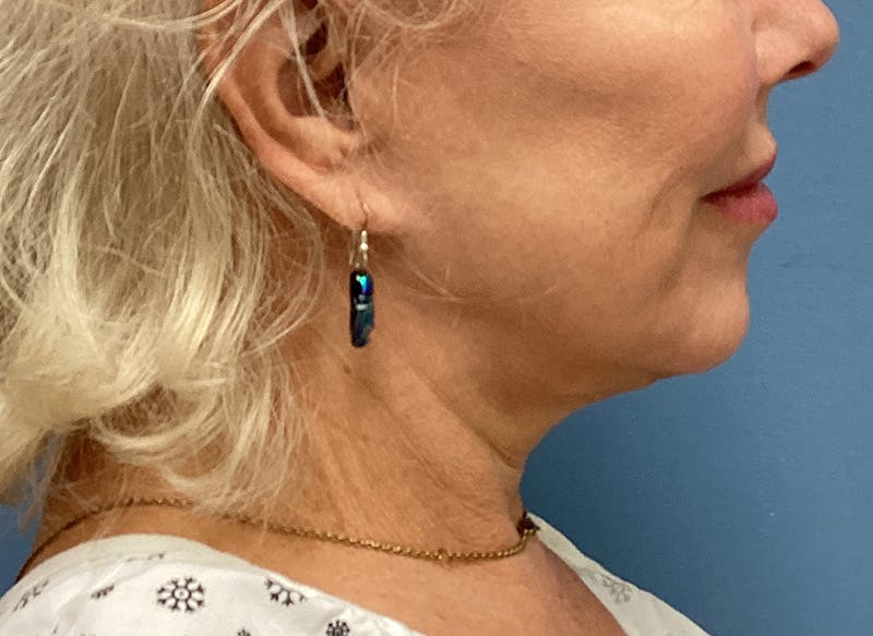 Neck Lift Before & After Gallery - Patient 151125 - Image 1