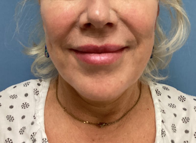 Neck Lift Before & After Gallery - Patient 151125 - Image 5