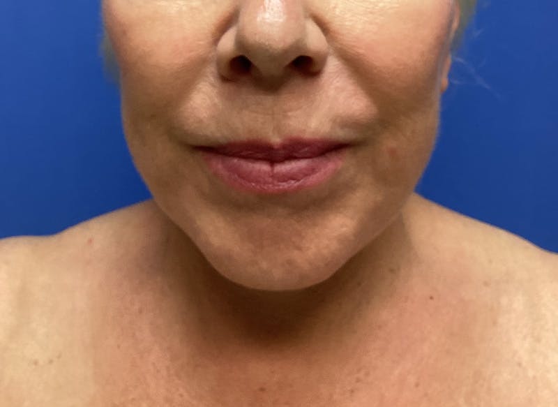 Neck Lift Before & After Gallery - Patient 151125 - Image 6