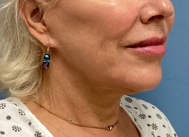 Neck Lift Before & After Gallery - Patient 151125 - Image 3