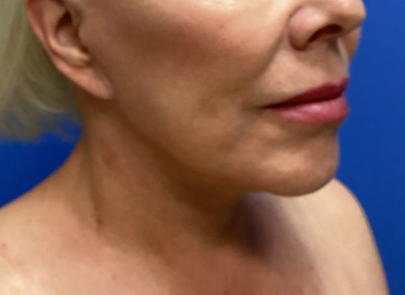 Neck Lift Before & After Gallery - Patient 151125 - Image 4