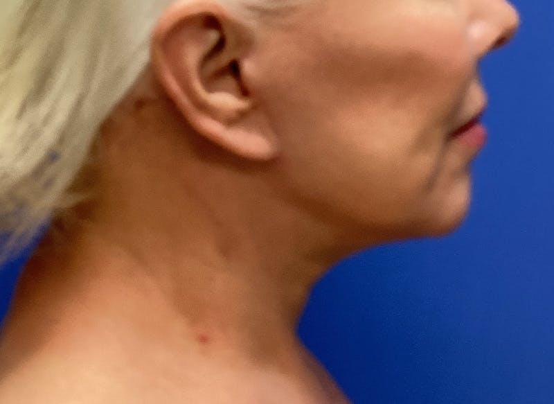 Neck Lift Before & After Gallery - Patient 151125 - Image 2