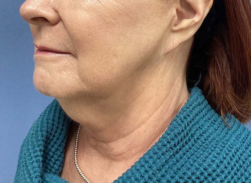 Before and after Neck Lift