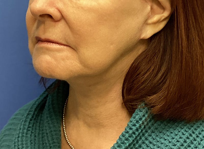 Before and after Neck Lift