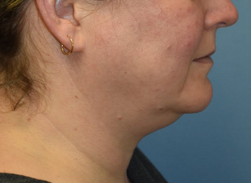 Before and after Neck Lift