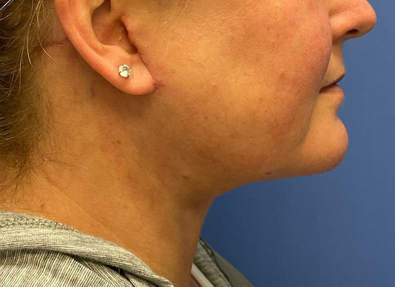 Before and after Neck Lift