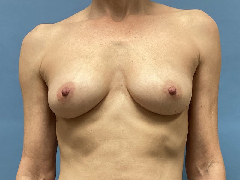 Before and after breast augmentation