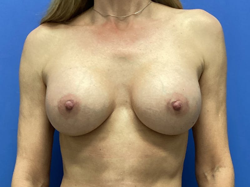 Before and after breast augmentation