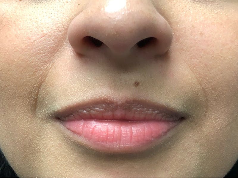 before and after lip augmentation