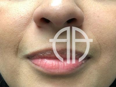 LIP FILLER Before & After Gallery - Patient 423246 - Image 1