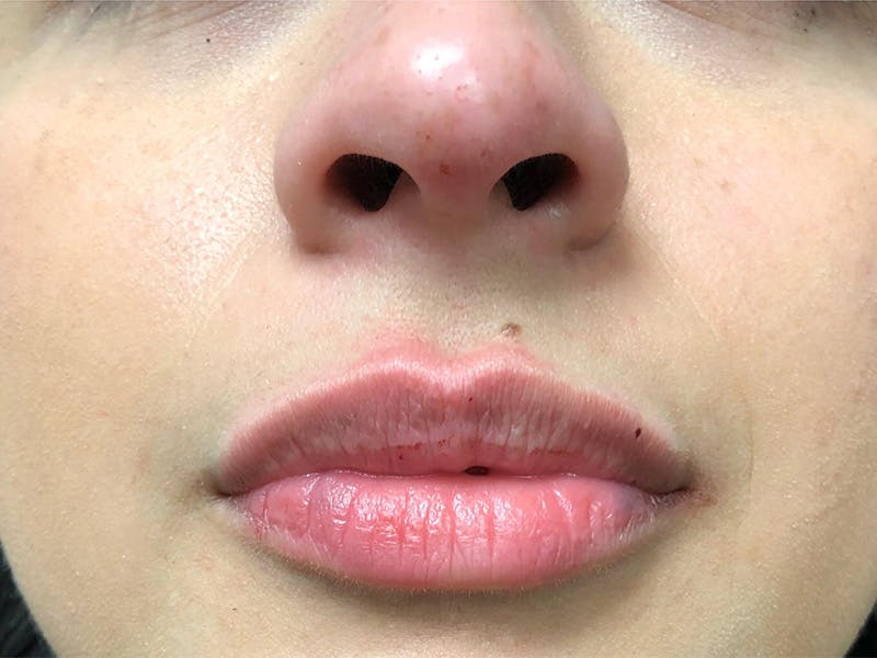 before and after lip augmentation