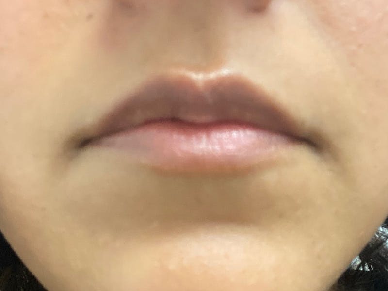 before and after lip augmentation