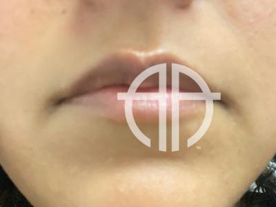 LIP FILLER Before & After Gallery - Patient 338930 - Image 1