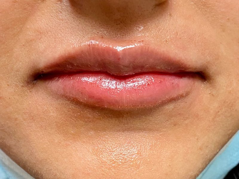 before and after lip augmentation