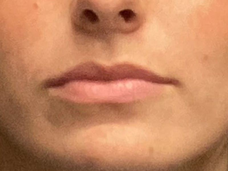 before and after lip augmentation
