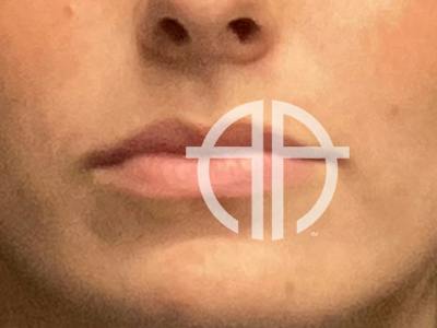 LIP FILLER Before & After Gallery - Patient 301974 - Image 1