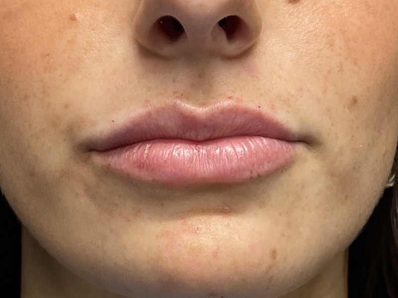DERMAL FILLERS Before & After Gallery - Patient 301974 - Image 2