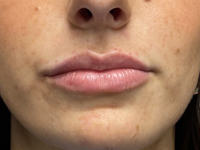 before and after lip augmentation