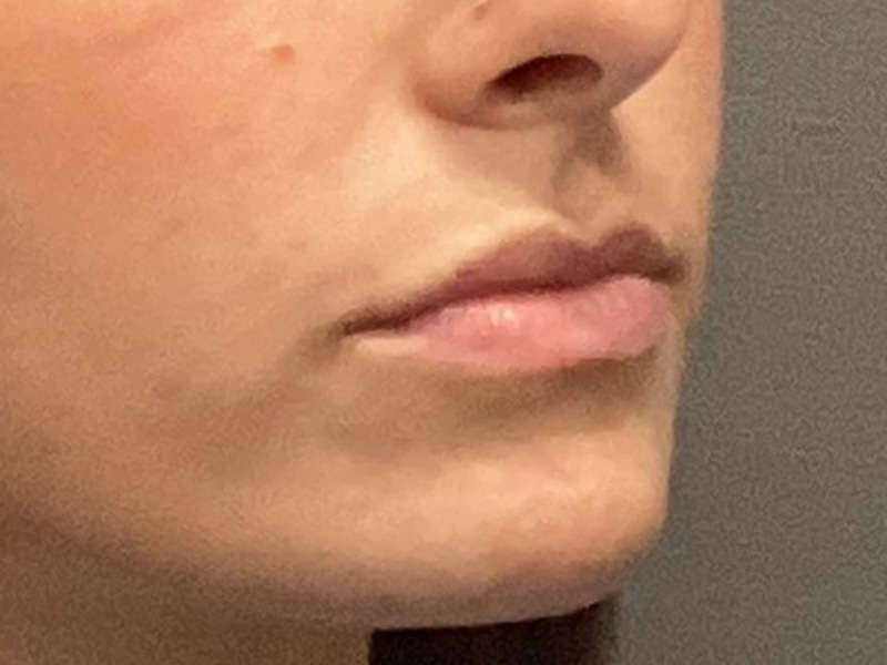 DERMAL FILLERS Before & After Gallery - Patient 301974 - Image 3