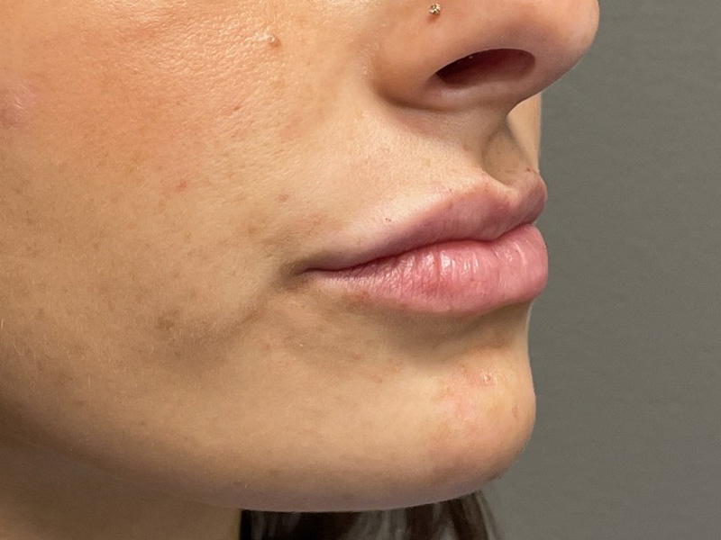 DERMAL FILLERS Before & After Gallery - Patient 301974 - Image 4