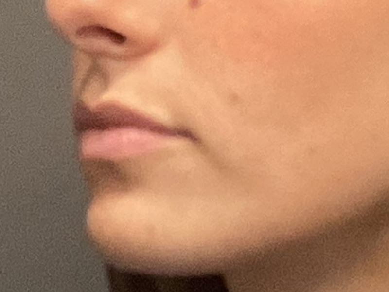 DERMAL FILLERS Before & After Gallery - Patient 301974 - Image 5