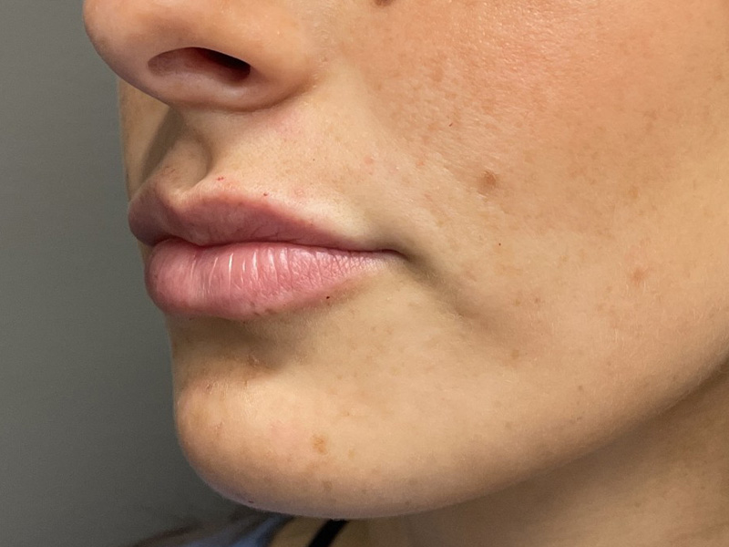 DERMAL FILLERS Before & After Gallery - Patient 301974 - Image 6