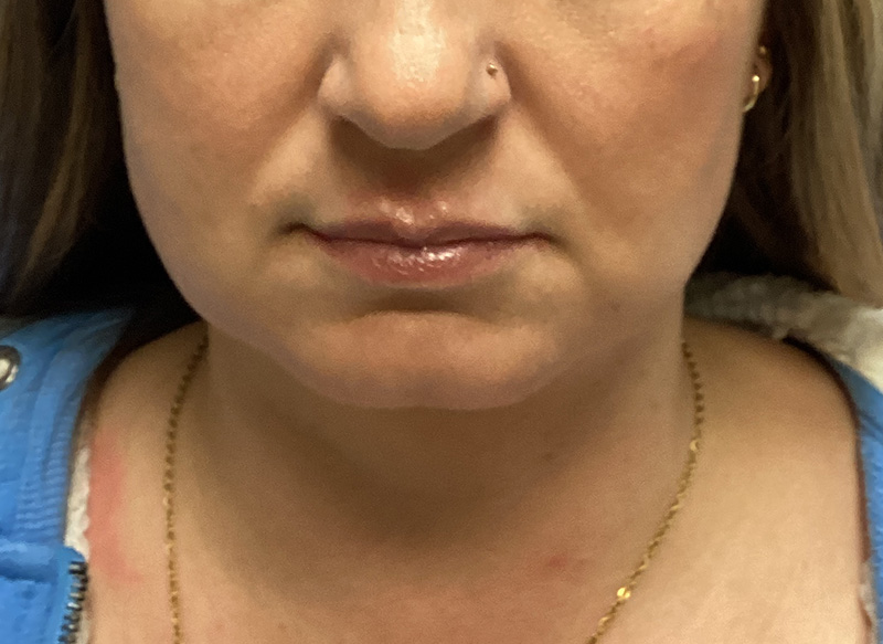 SUBMENTAL LIPOSUCTION Before & After Gallery - Patient 233653 - Image 4