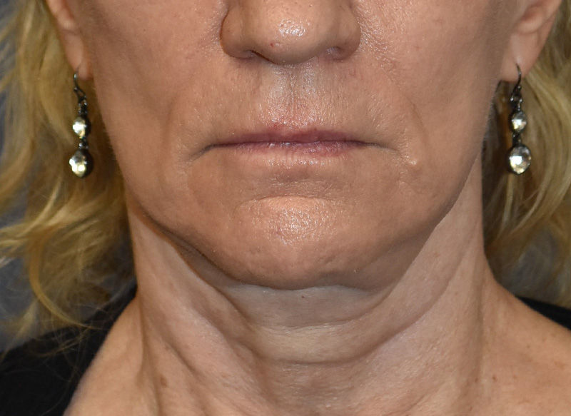 SUBMENTAL LIPOSUCTION Before & After Gallery - Patient 138990 - Image 5
