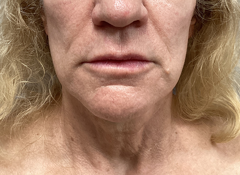 SUBMENTAL LIPOSUCTION Before & After Gallery - Patient 138990 - Image 6