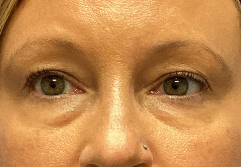 BLEPHAROPLASTY Before & After Gallery - Patient 379676 - Image 1